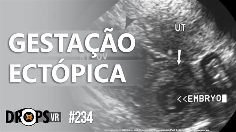 Gravidez Ect Pica Aparece No Ultrassom Quanto Tempo Maternidade