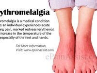 Erythromelalgia