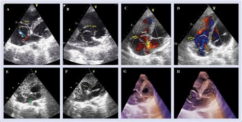 Transthoracic Echocardiography Tte In Modified Apical Four Chamber