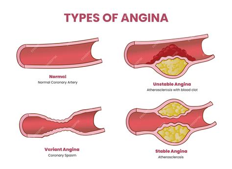 Premium Vector Types Of Angina Illustration