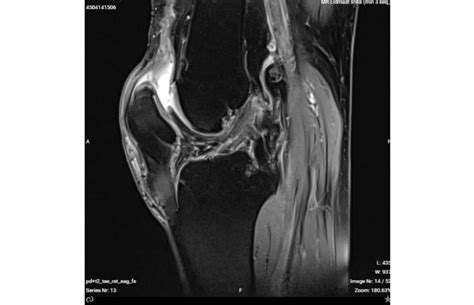 MRI showing the quadriceps lesion. | Download Scientific Diagram