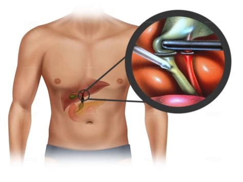 Bile Duct Cancer Treatment With Liver Surgery