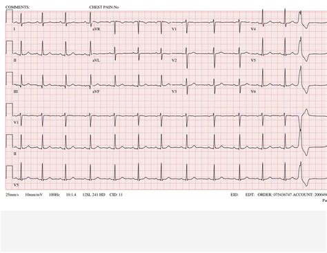 help understanding ekg result please!!! : r/PVCs