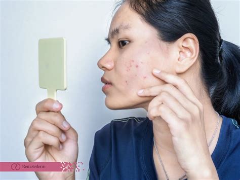 The best acne treatment for oily skin - Remotederm