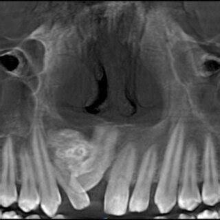 Preoperative Opg Reveals A Well Defined Radiopaque Mass With A