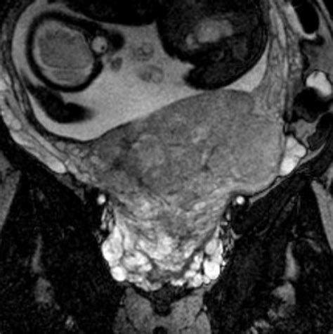 Coronal Bffe Sequence Of Placenta Previa Totalis With Hypertrophic