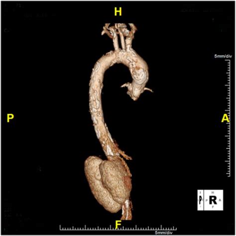 Preoperative Computed Tomography Angiogram 3d View Demonstrating Download Scientific Diagram