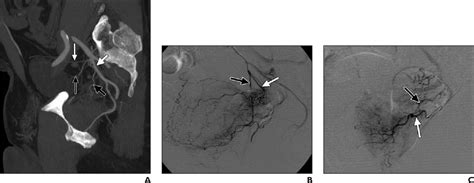 Angiographic Anatomy Of The Male Pelvic Arteries Semantic Scholar