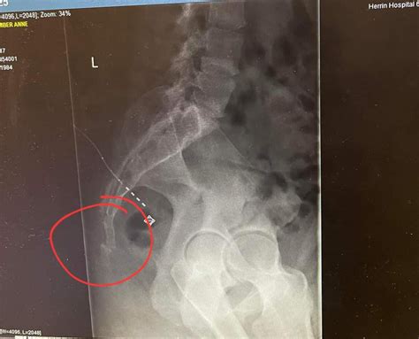 Coccyx Fracture Xray