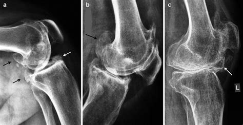 Osteophytes Knee