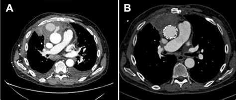 Figure From Transapical Thoracic Endovascular Aortic Repair As A