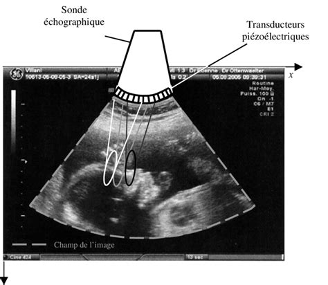 Principe de formation de l image la sonde échographique focalise des