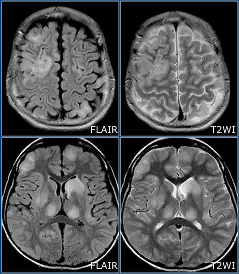 Ms Brain Mri With Contrast