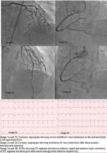 Multivessel Coronary Vasospasm Presenting As A St Segment Elevation