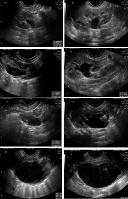 Fetal Hydronephrosis Ultrasound