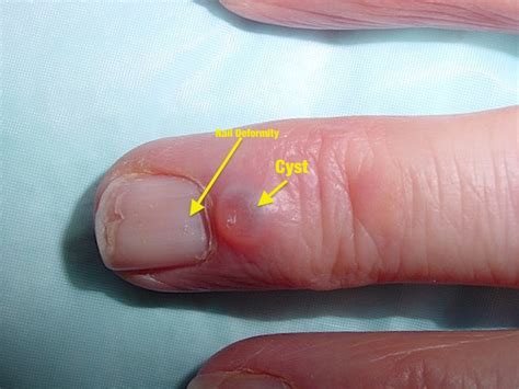 MUCOUS CYST Hand Surgery Resource