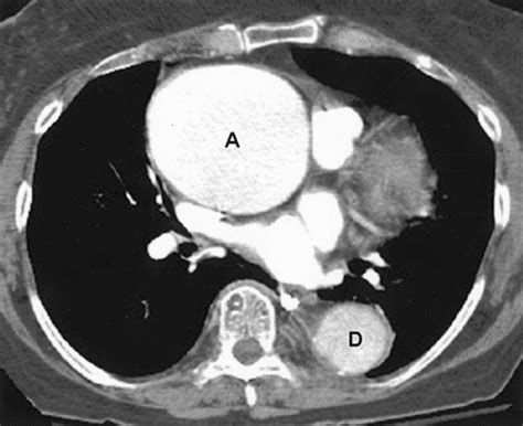 Thoracic And Abdominal Aortic Aneurysms Circulation