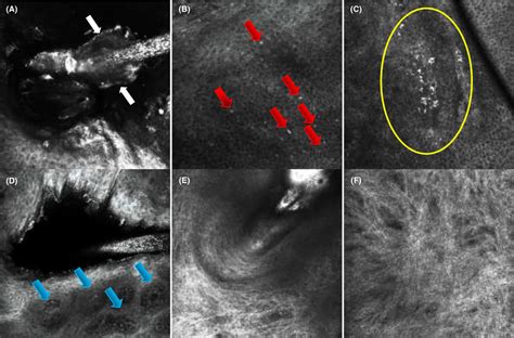 Lichen Planopilarisclassic Form Rcm Examination Shows Infundibular