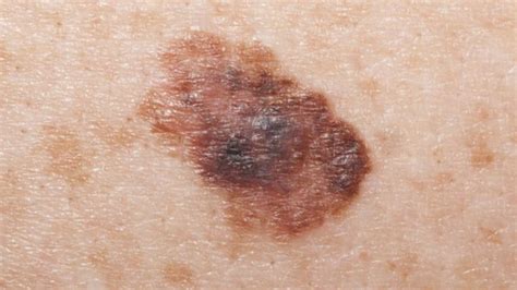 Green Light For New Skin Cancer Drug Bbc News