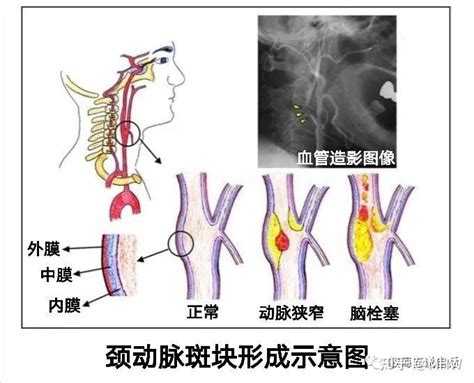 细说颈动脉斑块 知乎