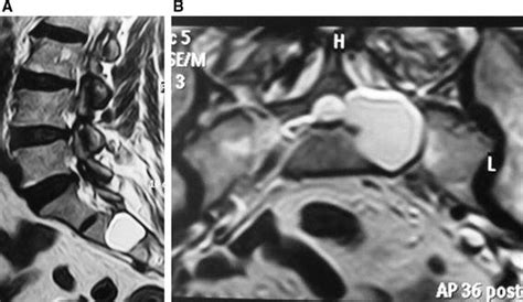 Preoperative Sagittal A And Axial B T2 Weighted Mri Images Showing