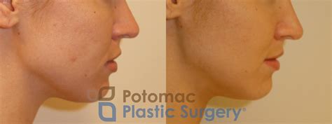 Nonsurgical Jaw Reduction With Botox Cosmetic To Sculpt The Face And