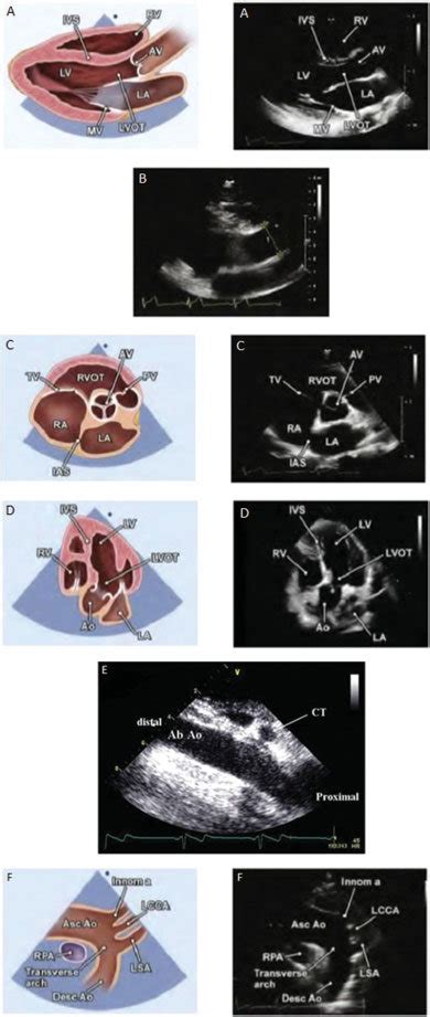 Canonical Views On Transthoracic Echo Tte A Parasternal Long Axis Download Scientific