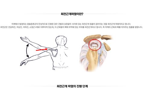 마디사랑병원 질환별 소개 어깨 회전근개파열