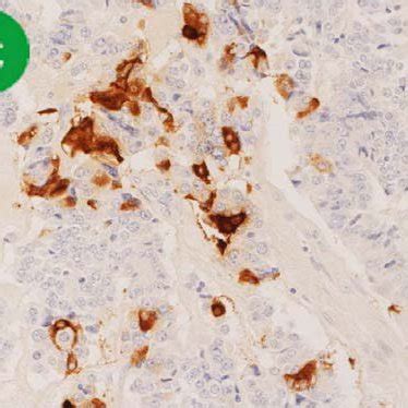 The Macroscopic And Histological Appearance Of The Resected Tumor A