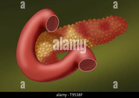 Zeigt Ein Pankreas Mit Einer Akuten Pankreatitis Unter Einem Normalen