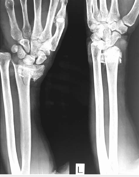 X Ray Of A Distal Radius Fracture Before Management Download