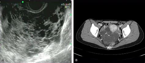 A Large Multilocular Hypoechogenic Cysts With Irregular Border On