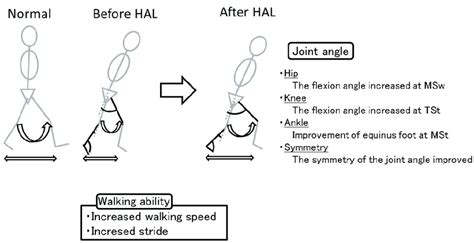 Gait pattern. The improvements in equinus gait and flexion angle of the... | Download Scientific ...