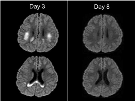 MRI of patient 2. On day 3, diffusion-weighted images reveal lesions in ...