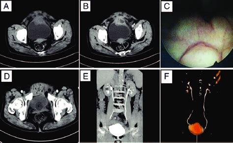 Images Of Computed Tomography Ct And Cystoscopy A And B Abdominal