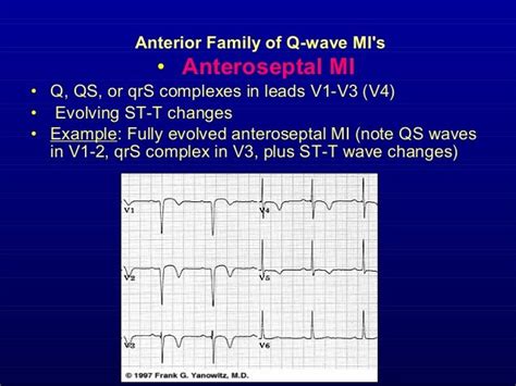 7th Part Ecg Basics Ecg Changes In Ihd Dr Salah Mabrouk