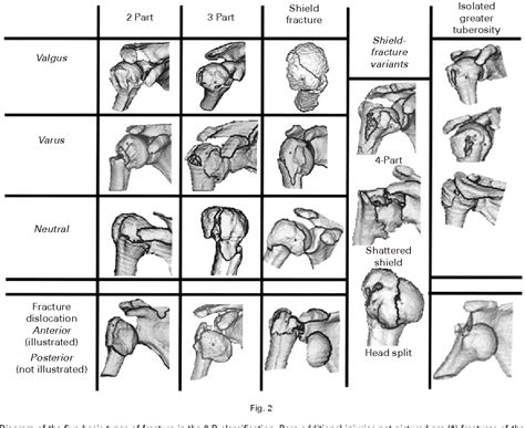 Neer Classification Of Humeral Head Fractures At Patrick Jefferson Blog