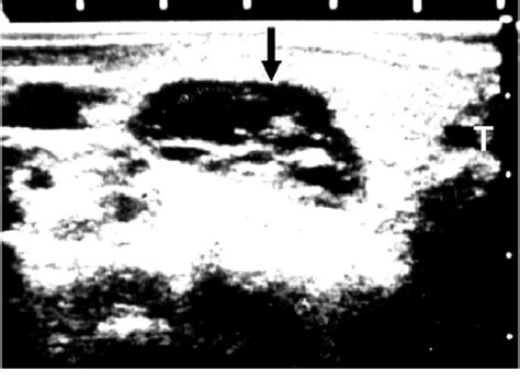 Parathyroid Ultrasonography Shows An Abnormal Enlargement Of The