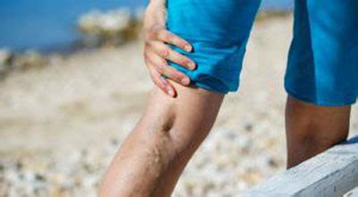 Varicose Veins More Than Just A Vanity Issue Myhealth Clinic