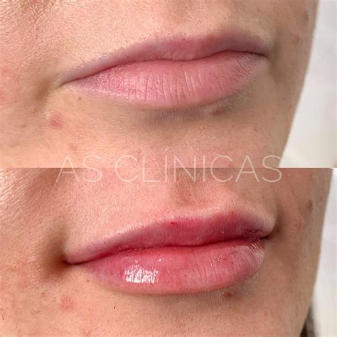 Preenchimento Labial Caso 2 As Clínicas