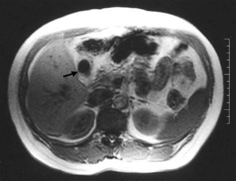 Mri Of Gallstones With Different Compositions Ajr