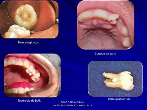 Imagenes Patologia Bucal