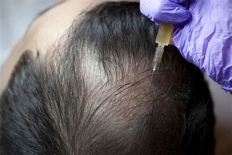 Platelet Rich Plasma For Hair Loss Halifax Naturopathic Doctor