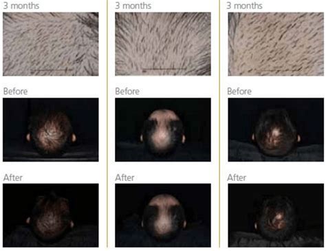 Producto Eficaz Para La Alopecia Visible En 90 Días Como Cortar El