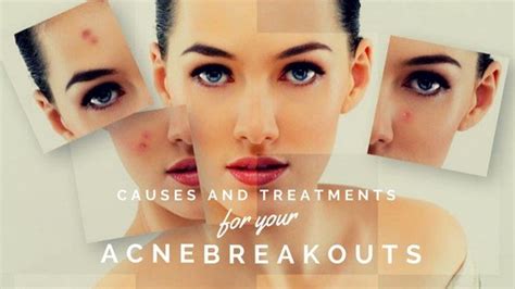 Causes and Treatments for Your Acne Breakouts - Associated Dermatologist