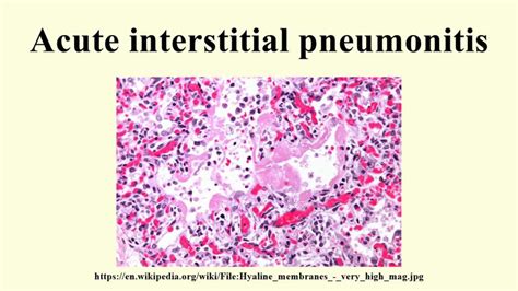 Interstitial Pneumonitis Nutrimedical