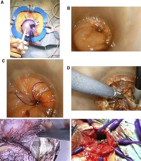 Transanal Total Mesorectal Excision Tatme In Rectal Cancer Treatment