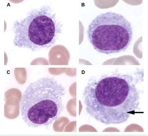 Figure 1 From Of North America Hairy Cell Leukemia Diagnostic Pathology Semantic Scholar