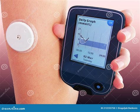 Device for Continuous Glucose Monitoring of Blood Sugar Levels â€“ CGM Stock Photo - Image of ...