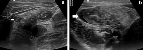 Case 1 Us Abdomen In A 6 Year Old Girl Who Presented With Back And Download Scientific Diagram